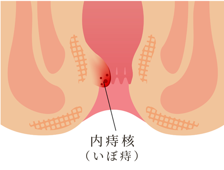 いぼ痔(内痔核)について