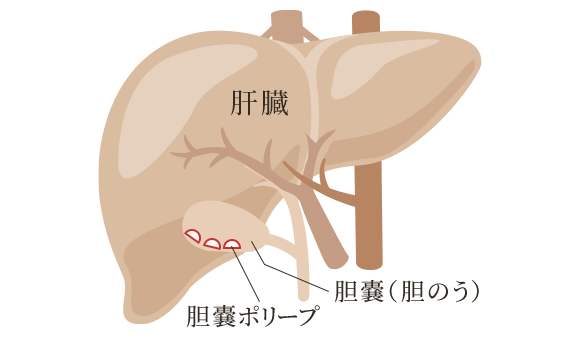 胆嚢ポリープとは？