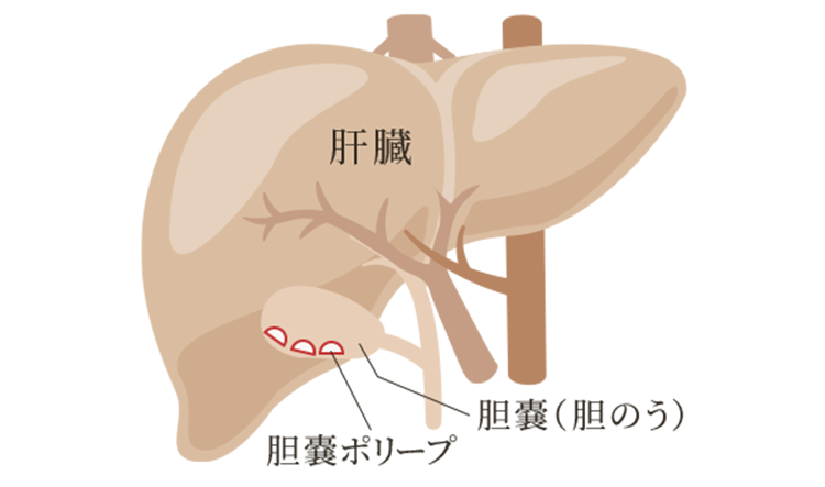 胆嚢ポリープとは？