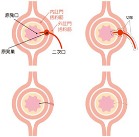 瘻管切開開放術（lay open法）