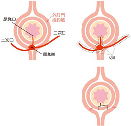 括約筋温存術（くりぬき法）