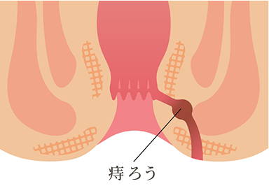 肛門周囲膿瘍が進行して発症した病態です。