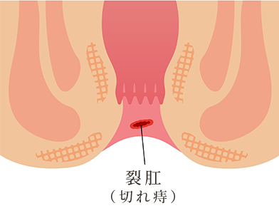 切れ痔（裂肛）