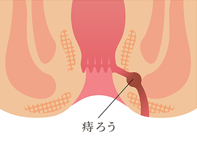 痔ろう（穴痔）