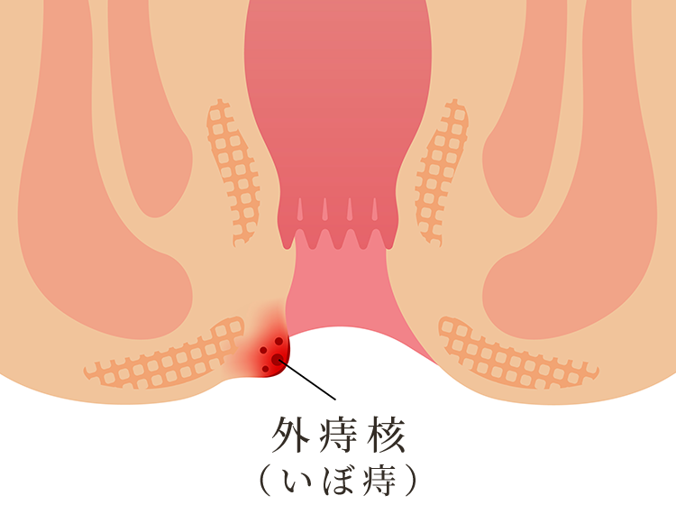 外痔核