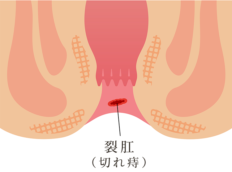 切れ痔（裂肛）