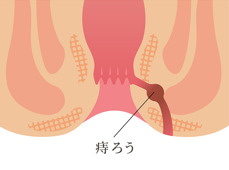 痔ろう（穴痔）