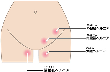 鼠径ヘルニアの種類