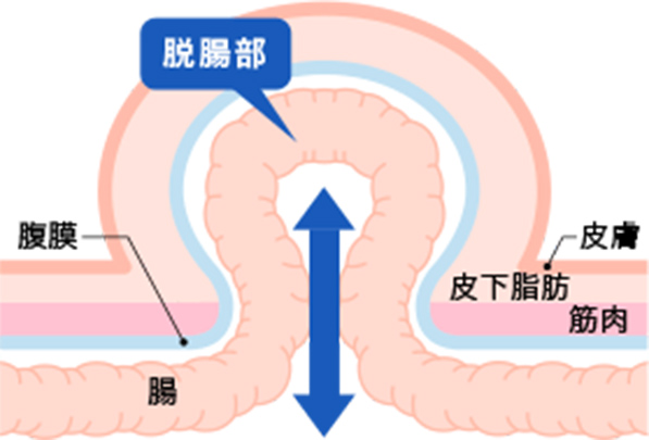 鼠径ヘルニアとは?
