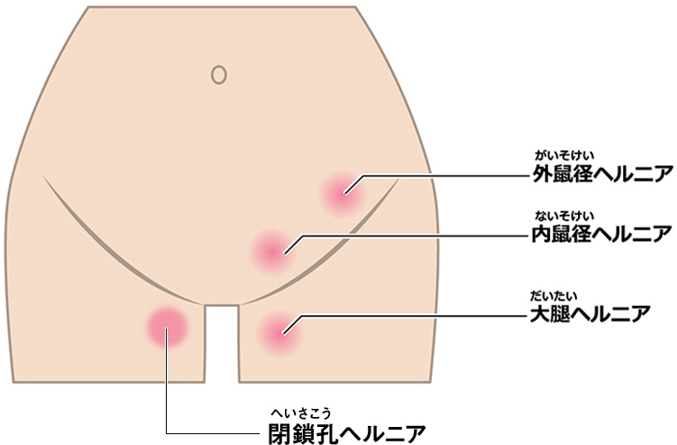 鼠径ヘルニアの種類