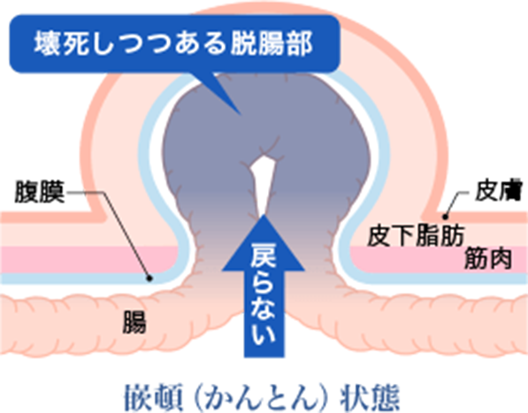 嵌頓(かんとん)とは