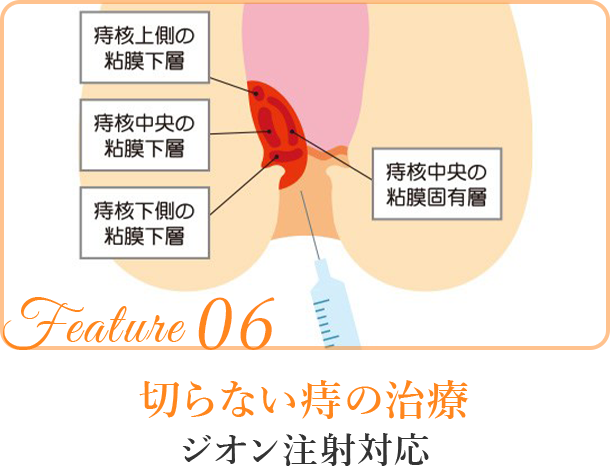 切らない痔の治療ジオン注射対応