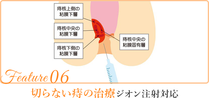 切らない痔の治療ジオン注射対応
