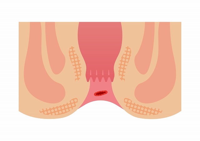 切れ痔（裂肛）について