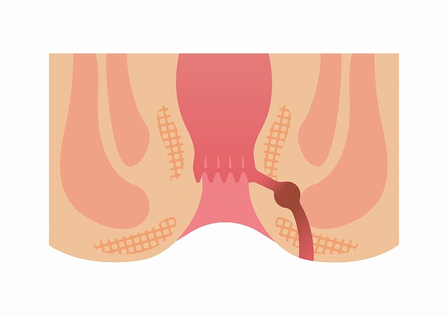 肛門周囲膿瘍：進行した痔ろうからの発症状態