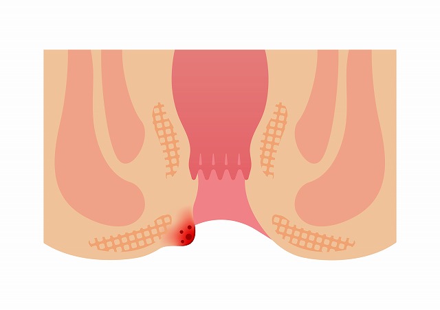 血栓性外痔核について