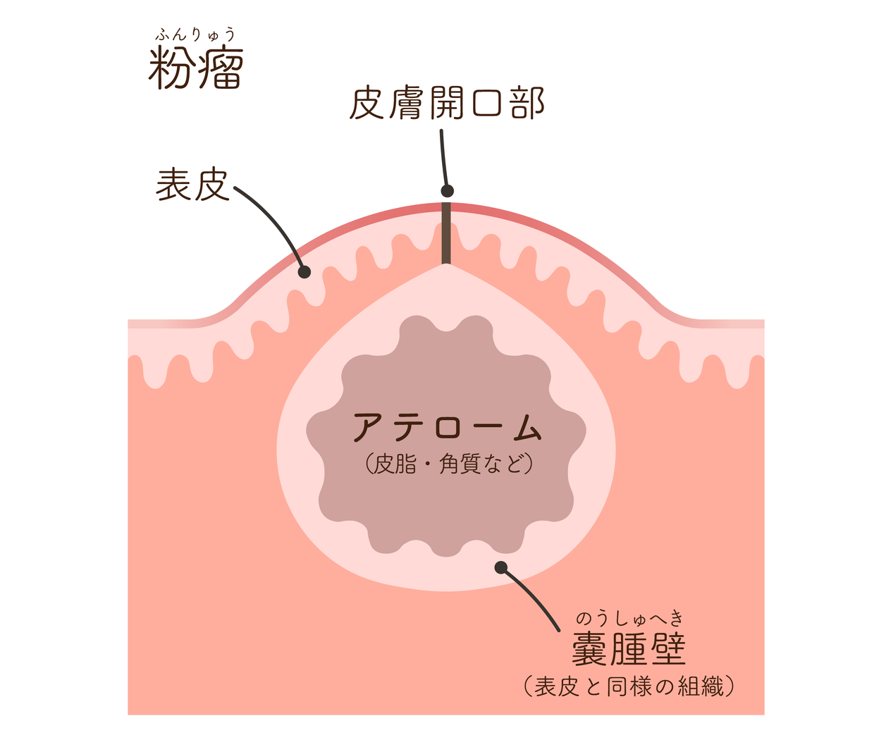 粉瘤のメカニズムと考えられる原因